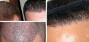 General Information for Those Who Want Beard Transplantation