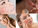 Hassas Cilt Nedir? Belirtileri ve Nedenleri