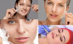 Cilt Soydurma Nedir?