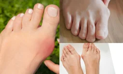 Halluks Rigidus Ameliyatı Sonrası İyileşme Süreci