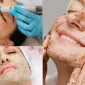 Cilt Bakımında Peeling Önemi Nedir?