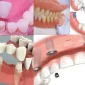 Protetik Diş Tedavisi Nedir? Nasıl Uygulanır?